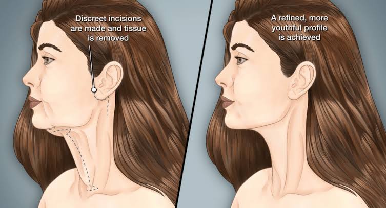 Neck lift without facelift