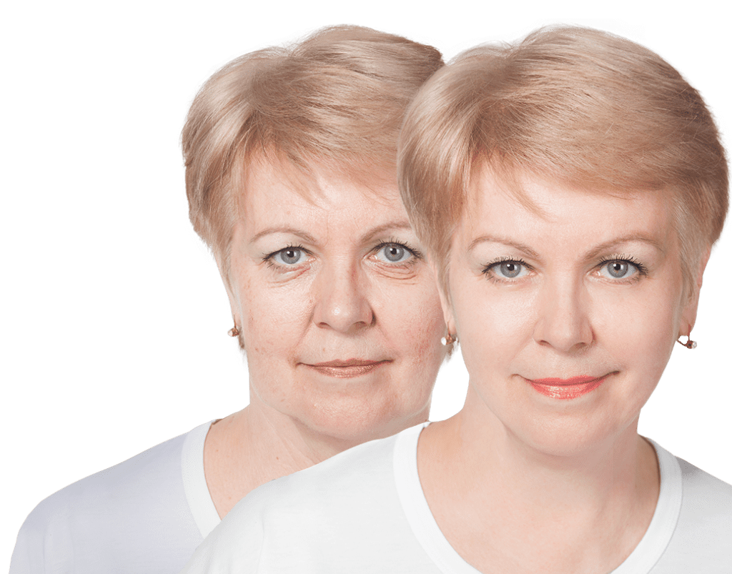 Woman face lift results How long facelift last