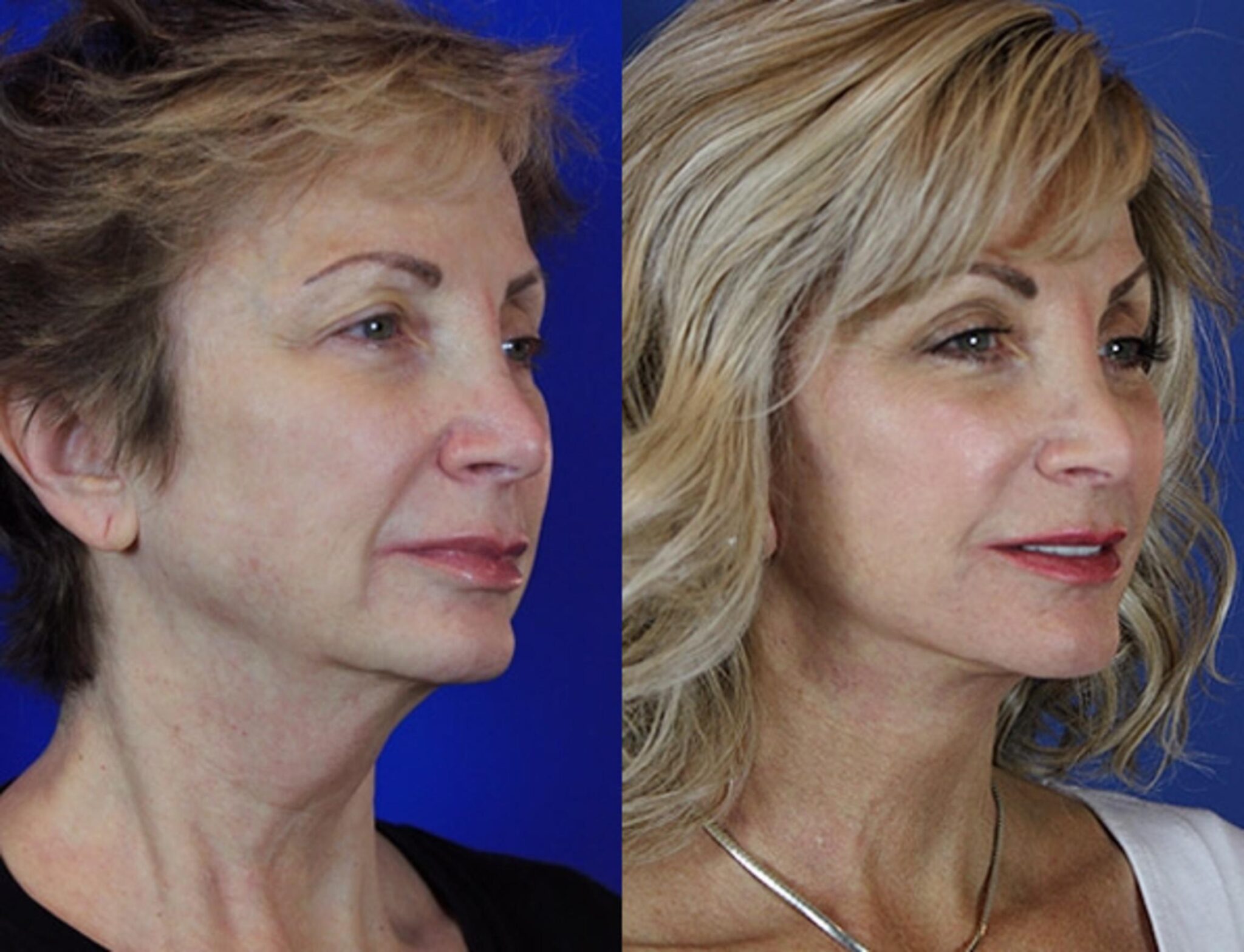 Non surgical facelift? Cryoskin Facelift is the answer Aesthetic