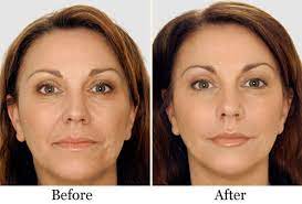 Liquid facelift for jowls- before and after