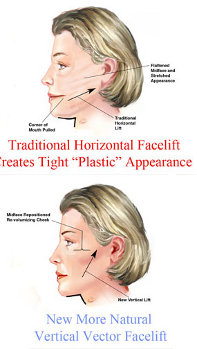 What is a vertical facelift