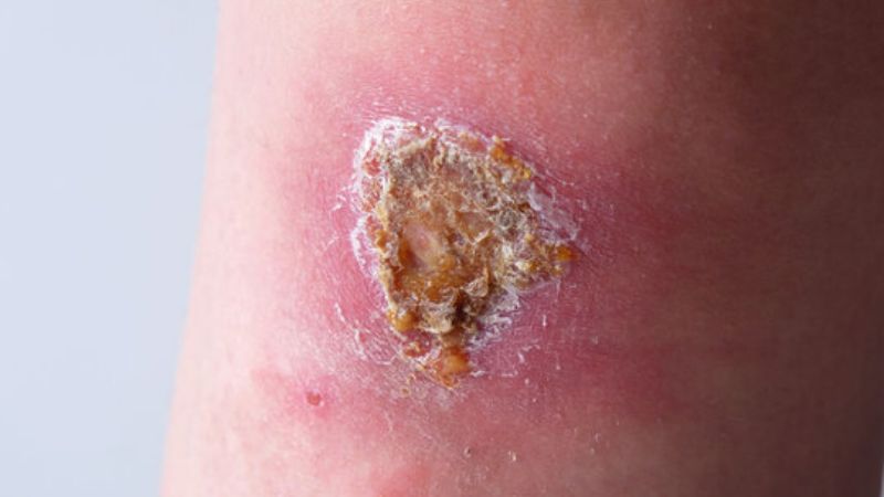 signs of wound infection