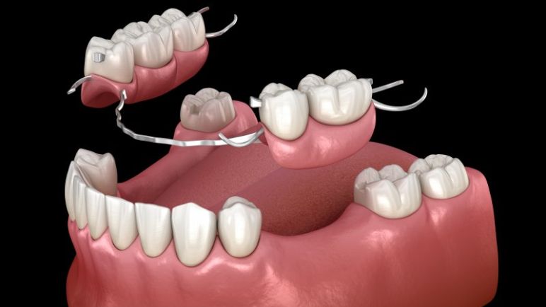 types of partial dentures
